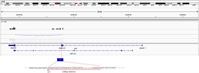 Next-generation sequencing reveals a case of Norrie disease in a child with bilateral ocular malformation